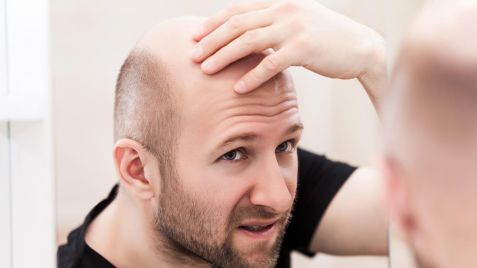 Alopecia: ¿Cómo se mide el avance de la calvicie?