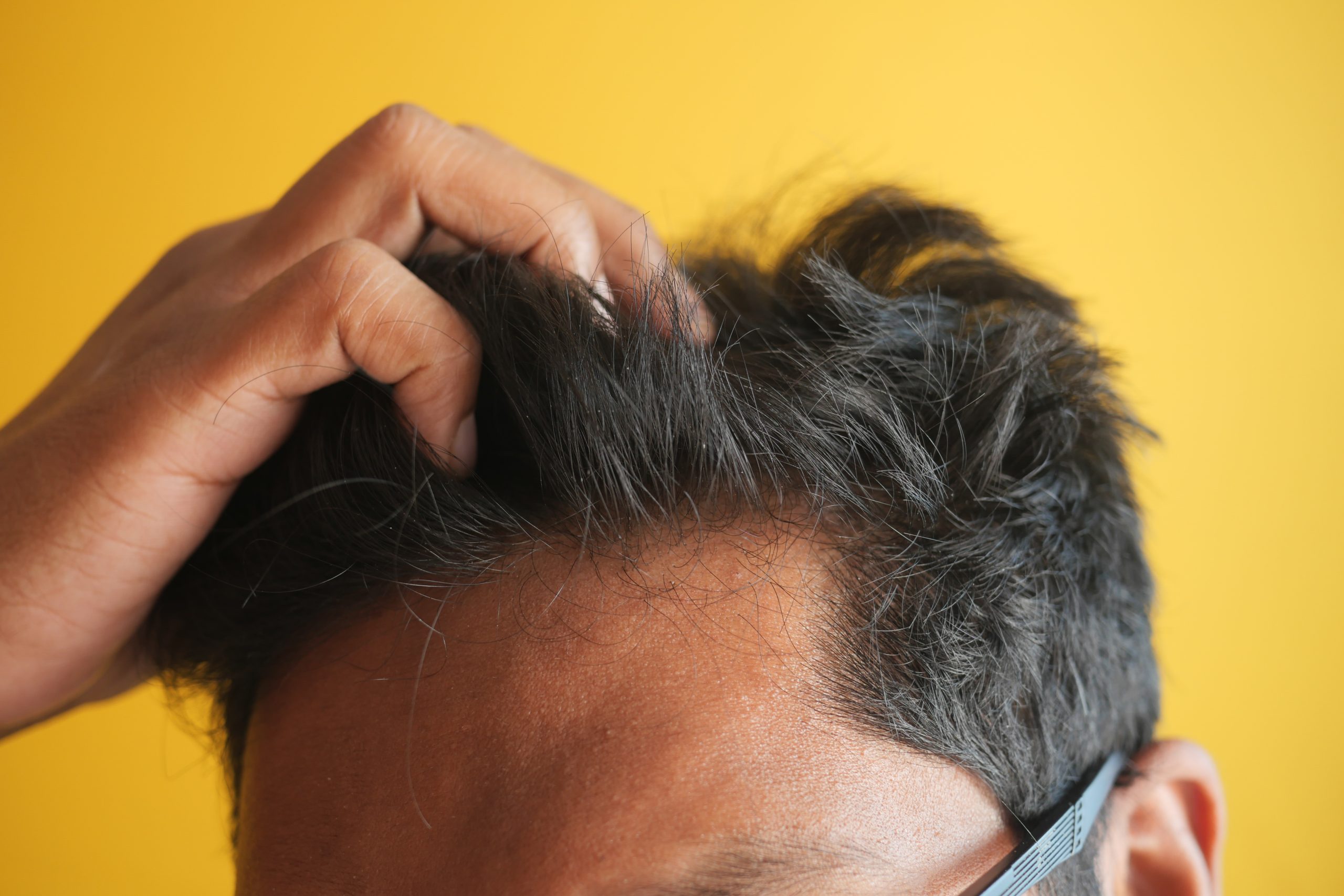 Crecer el pelo tras injerto capilar: evolución real con técnica FUE mes a mes