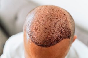caída de pelo tras injerto capilar