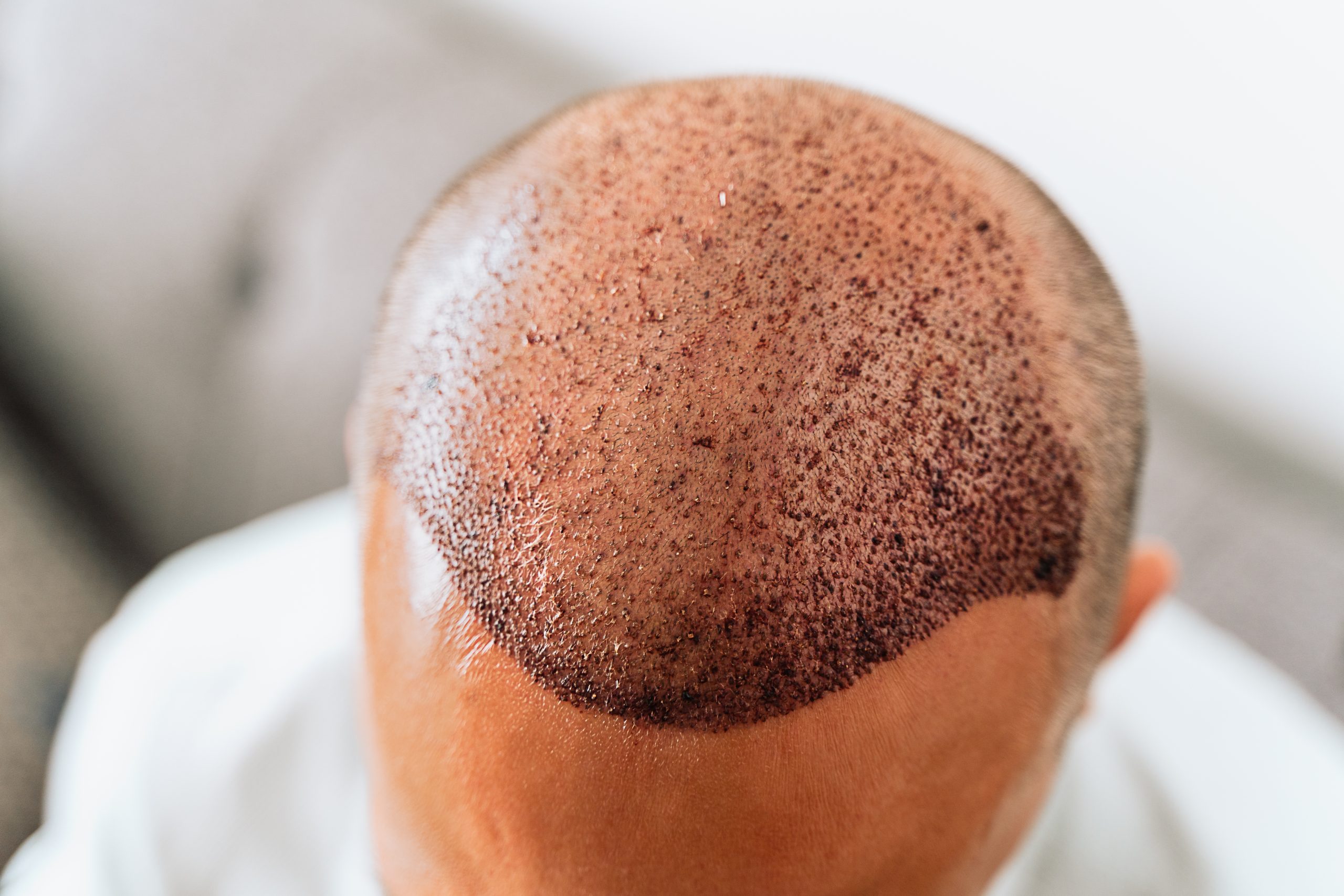 Caída de pelo tras injerto capilar: fases normales según el seguimiento médico